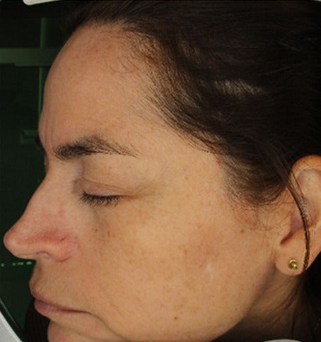 Clinical study participant, left profile, after
