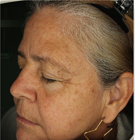 Clinical study participant, left profile, before