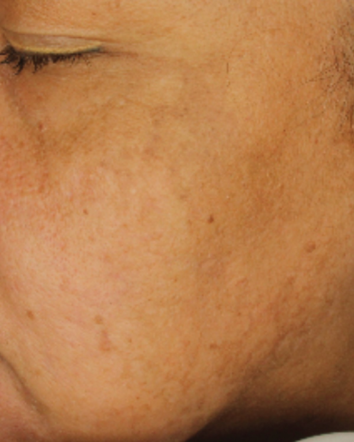 Clinical study participant, close-up of the cheek and eye area, after