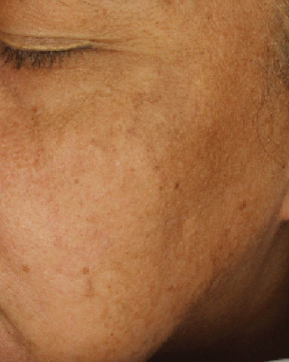 Clinical study participant, close-up of the cheek and eye area, before