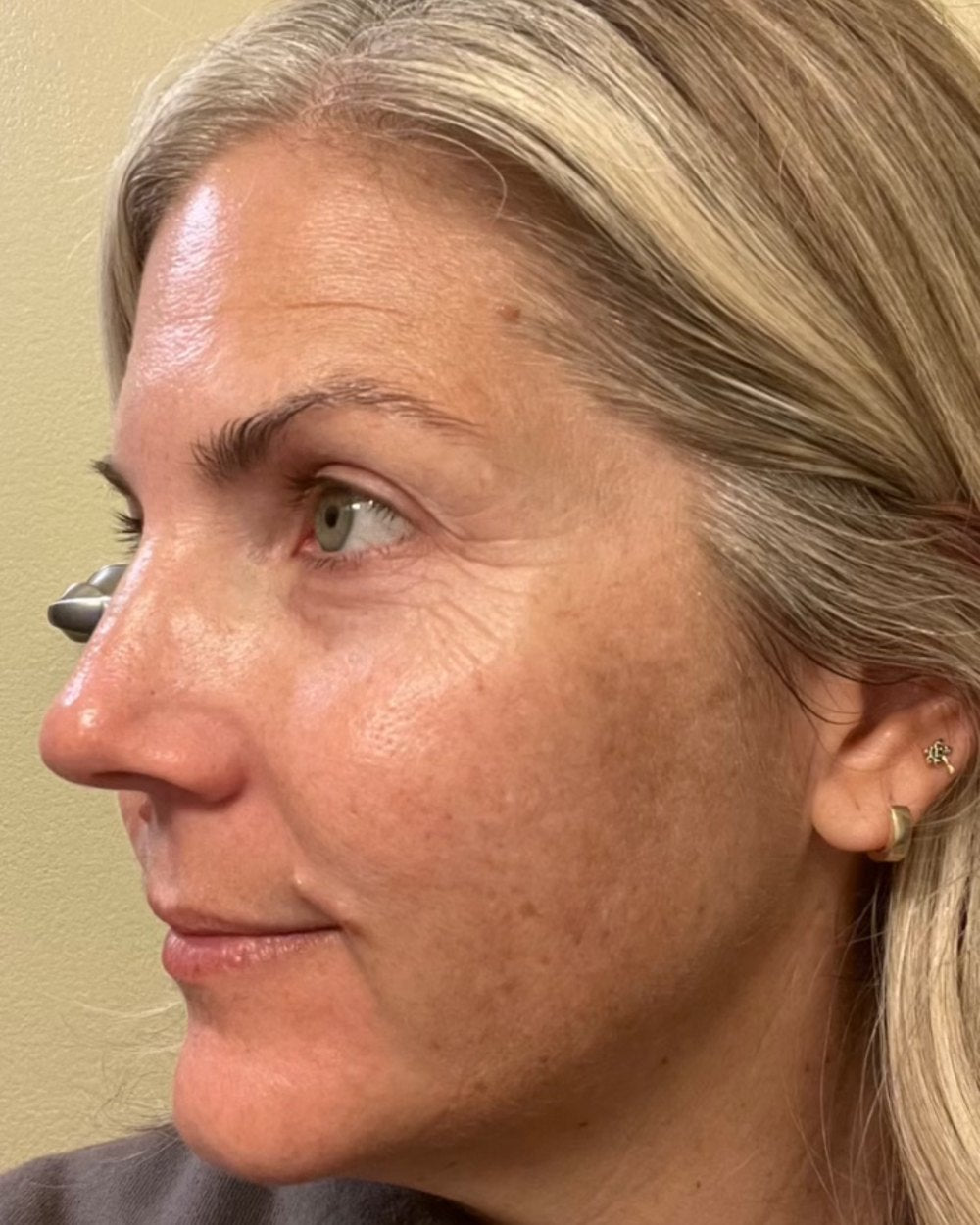 Cotrini customer, right profile, after