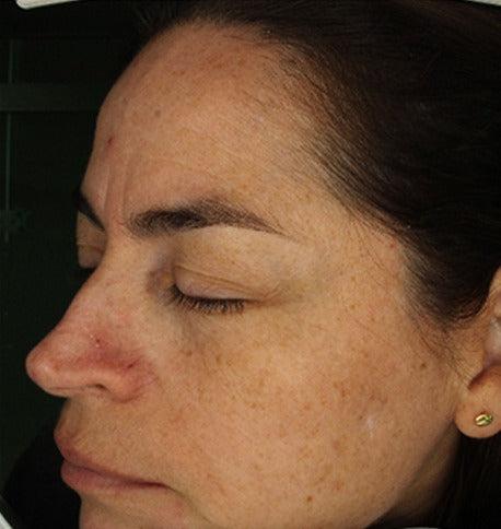 Clinical study participant, left profile, before