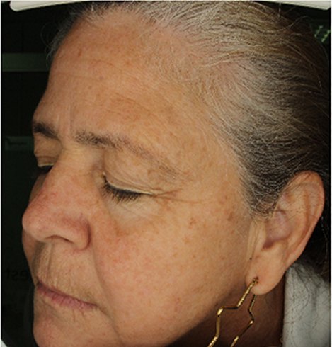 Clinical study participant, left profile, after